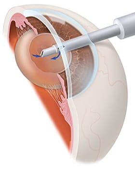 1761099742_CATARACT-REMOVAL Cataract Surgery in the Hudson Valley