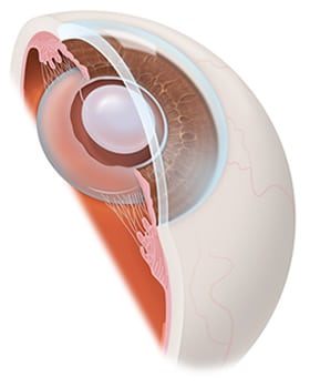 1761099746_LENS-REPLACEMTN Cataract Surgery in the Hudson Valley